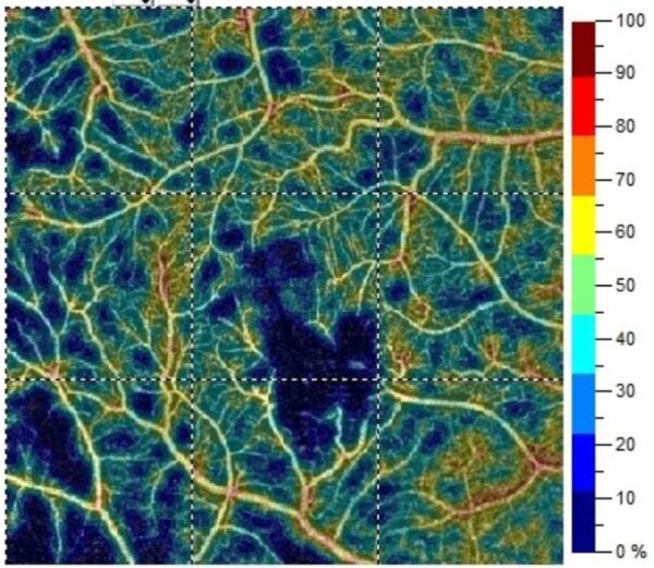 Optovue Angiovue - Image 2