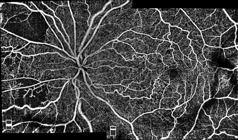 Optovue Angiovue - Image 3